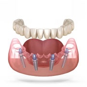 implant-4