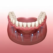 implant-6