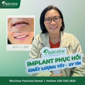 Dịch vụ cấy ghép Implant