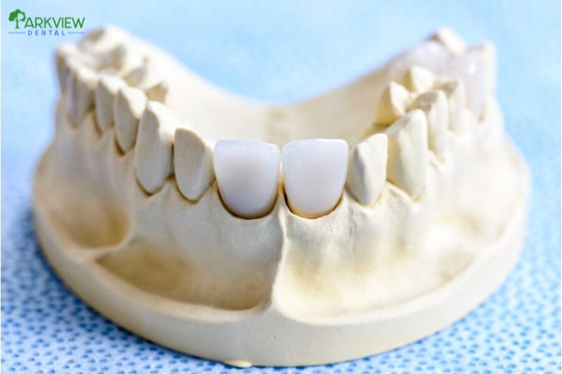 Bọc răng sứ Cercon giá dao động từ 5.000.000 - 15.000.000