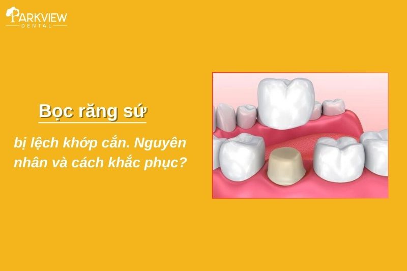Bọc răng sứ bị lệch khớp cắn: Nguyên nhân và cách khắc phục