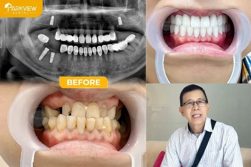 Bọc răng sứ là phương pháp phục hình nha khoa giúp khôi phục hình dạng, màu sắc và chức năng của răng