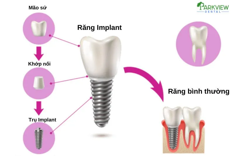 Hình ảnh minh họa răng Implant