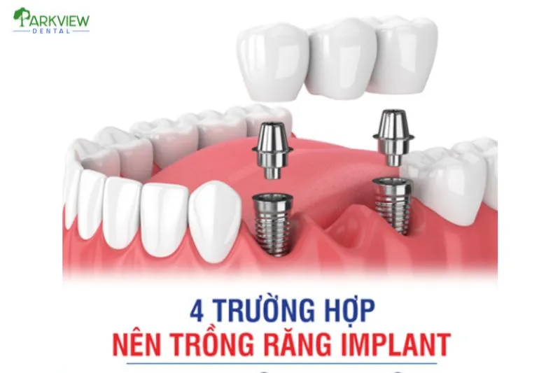 Những trường hợp nên trồng răng Implant
