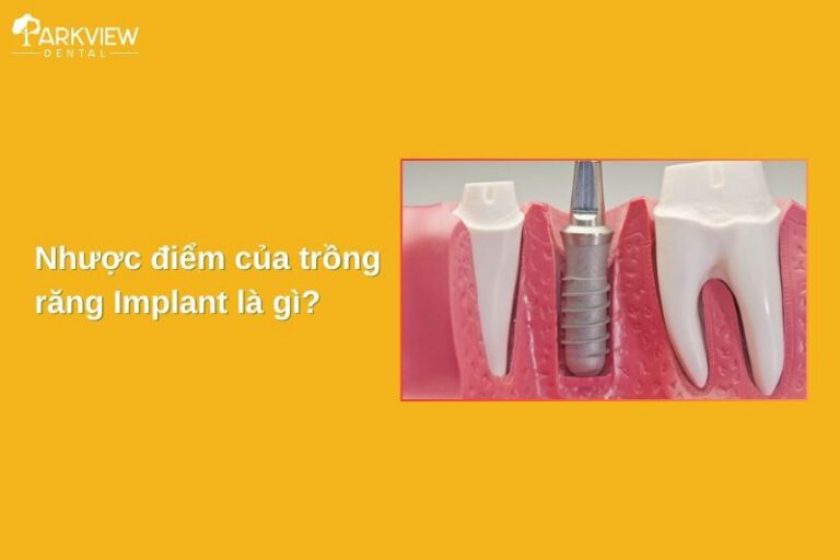 nhược điểm của trồng răng implant