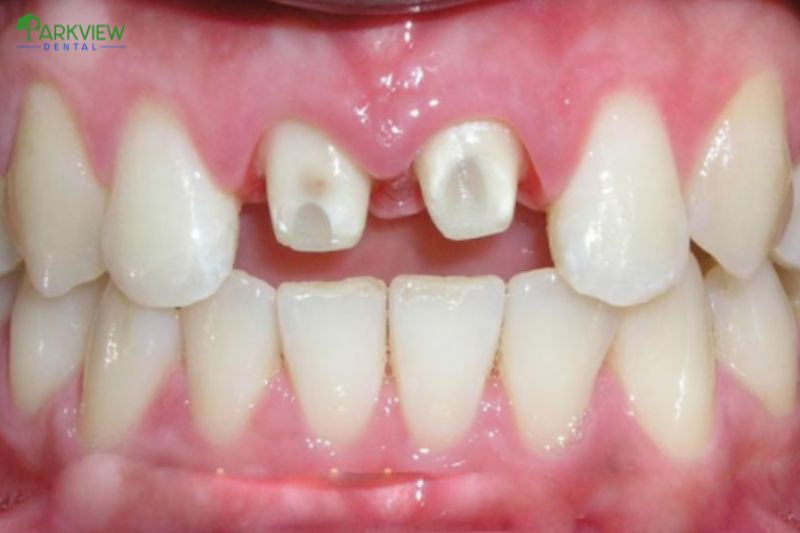 Hình ảnh răng bị mài nhỏ quá nhiều làm ảnh hưởng đến răng thật