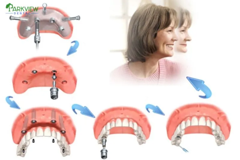 Quy trình trồng răng Implant All On 4