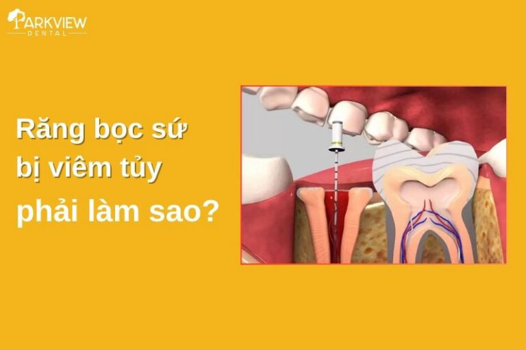 răng bọc sứ bị viêm tuỷ