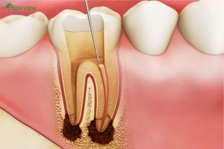 Răng sứ bị viêm tủy có nguy hiểm như thế nào