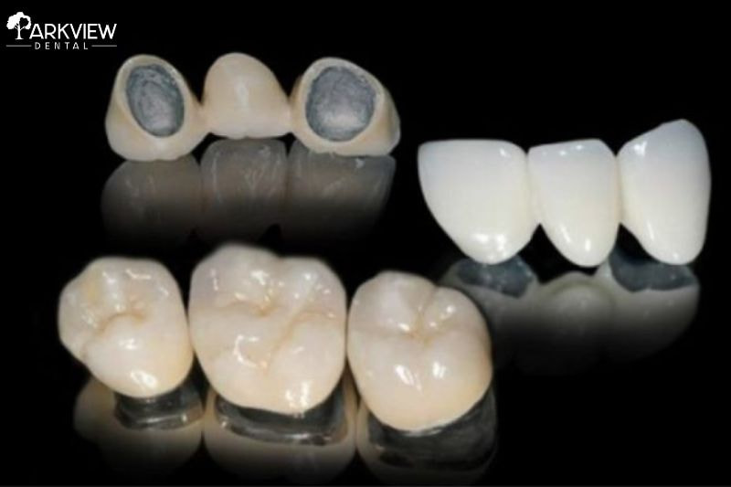 Răng sứ kim loại thường