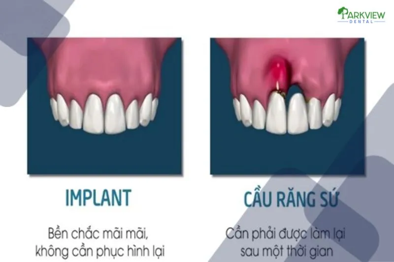 Sự khác nhau giữa trồng răng sứ và trồng răng Implant