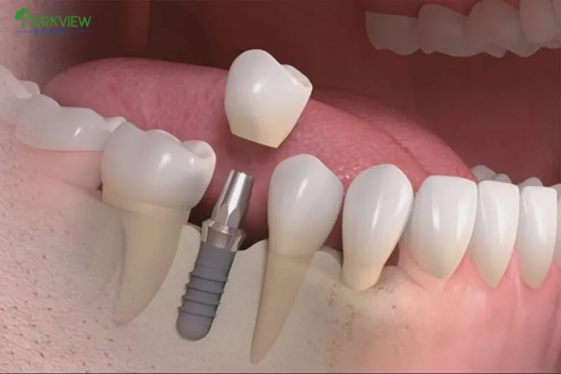 Trồng răng Implant đau trong bao lâu?