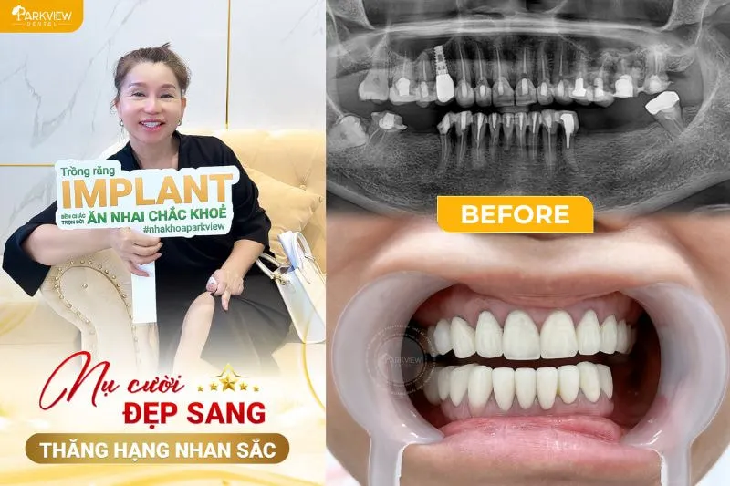 Khách hàng trồng răng Implant tại Nha khoa Parkview