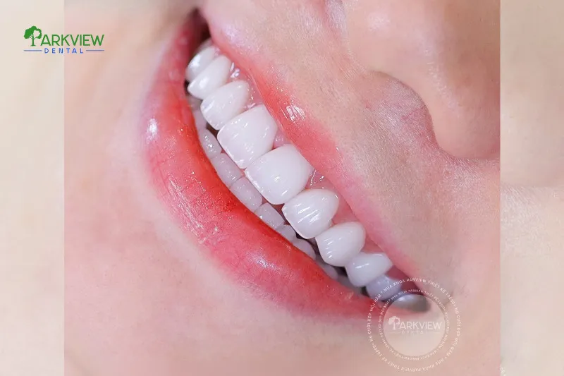 Răng sứ Lava giá bao nhiêu?