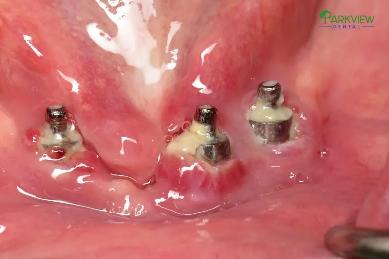 Viêm nhiễm quanh trụ Implant (Peri-implantitis)