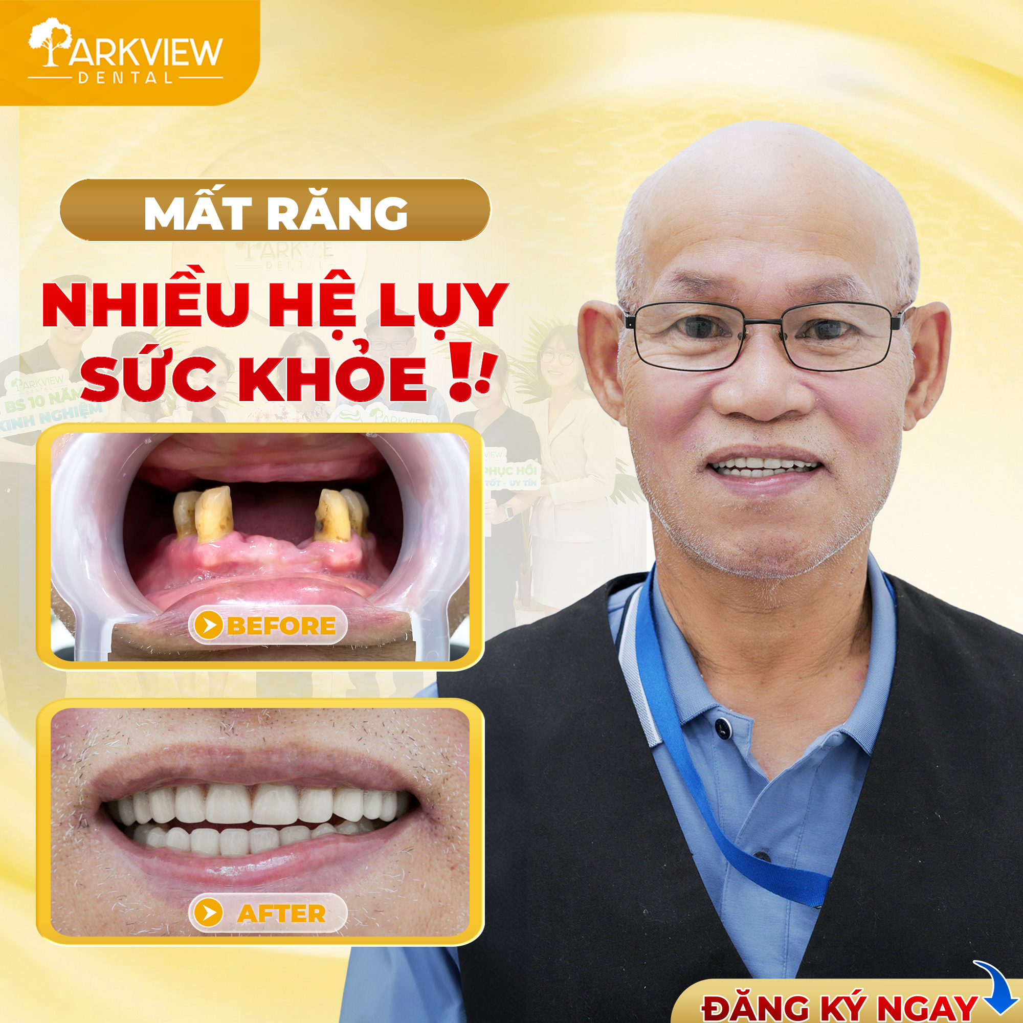Bảng giá Implant mới nhất 2025
