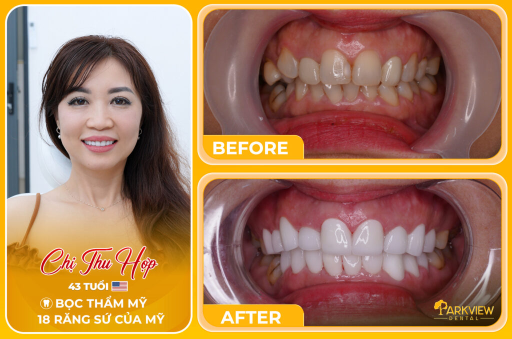 Trước và sau điều trị