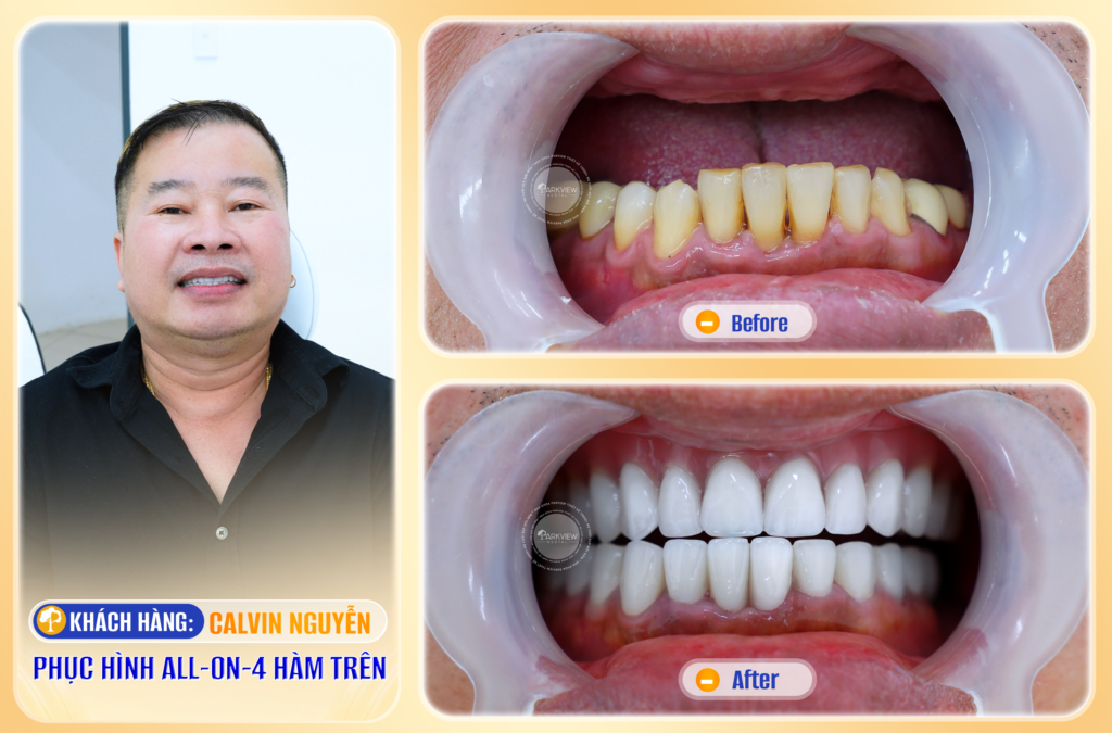 Trước và sau điều trị