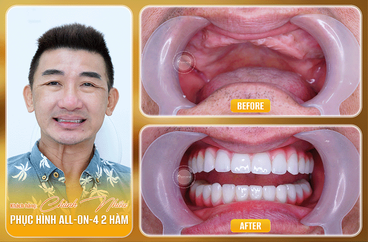 Trước và sau điều trị