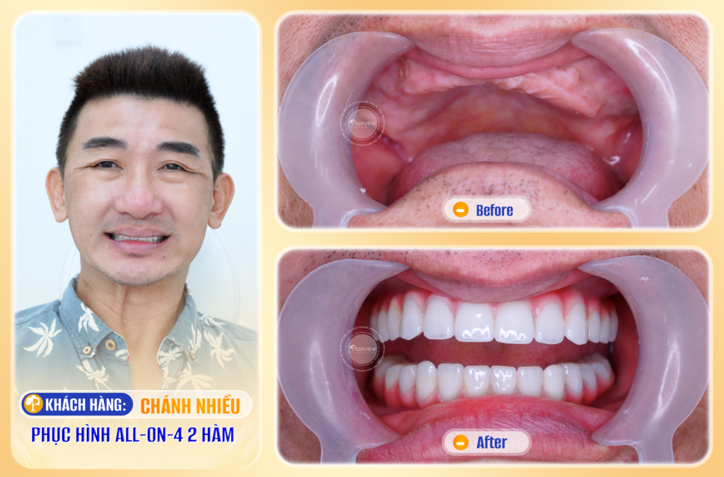 Trước và sau điều trị