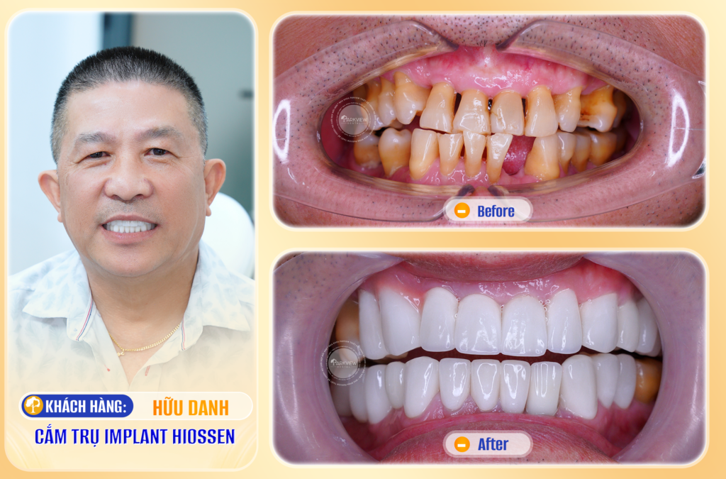 Trước và sau điều trị