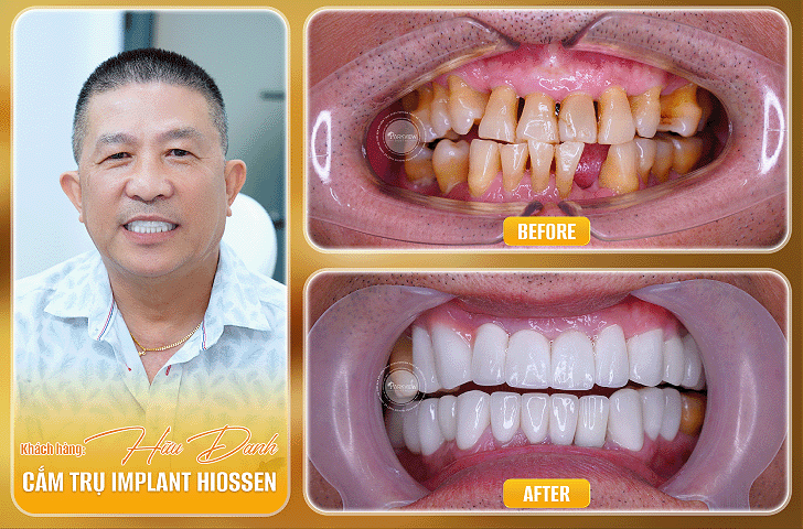 Trước và sau điều trị