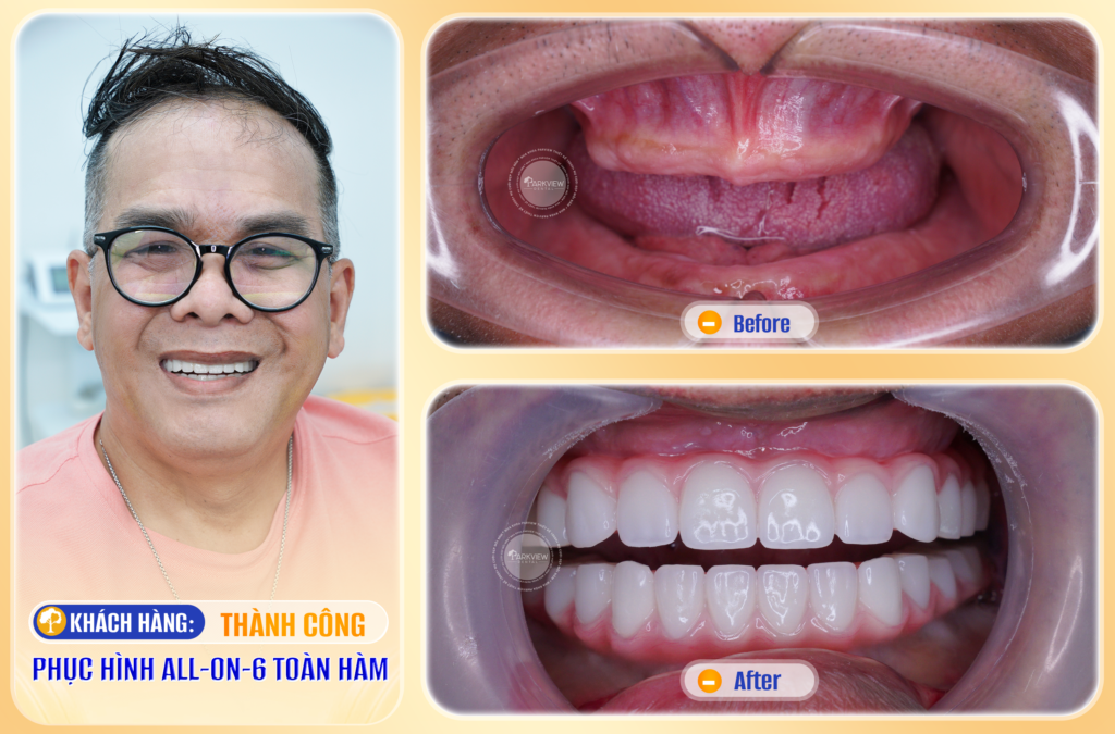 Trước và sau điều trị