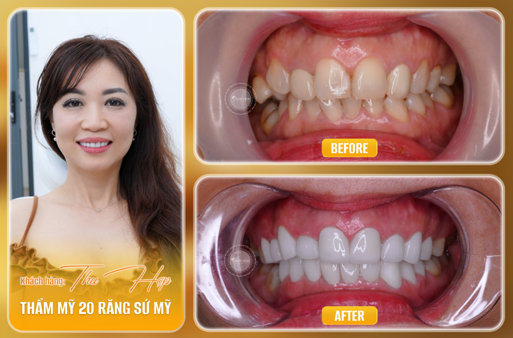 Trước và sau điều trị