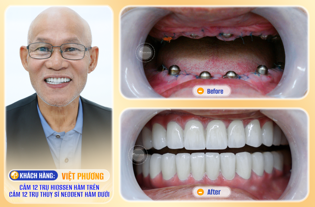 Trước và sau điều trị