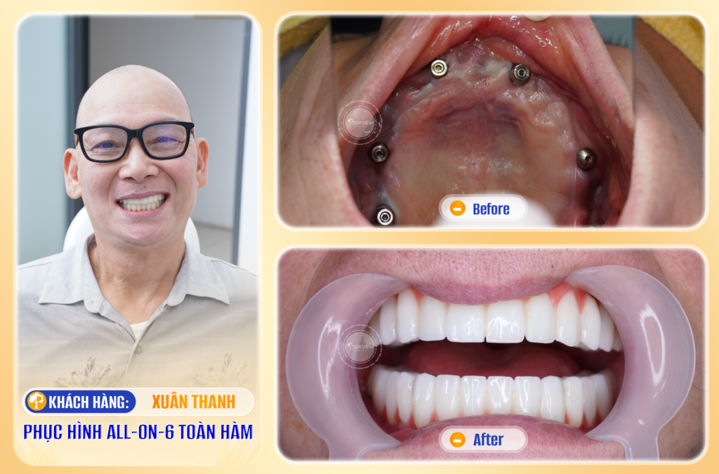 Trước và sau điều trị