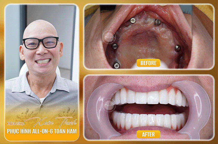 Trước và sau điều trị