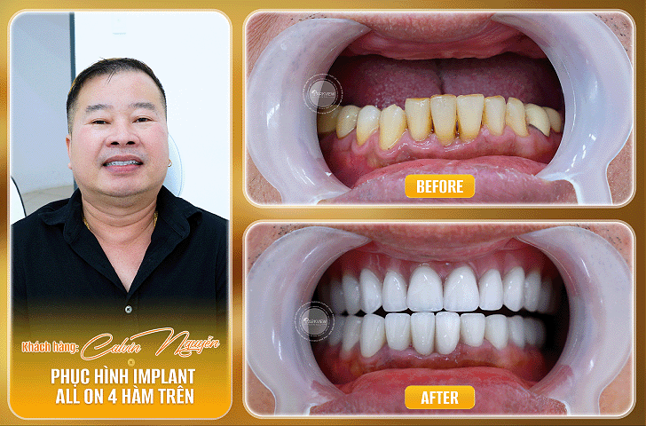 Trước và sau điều trị