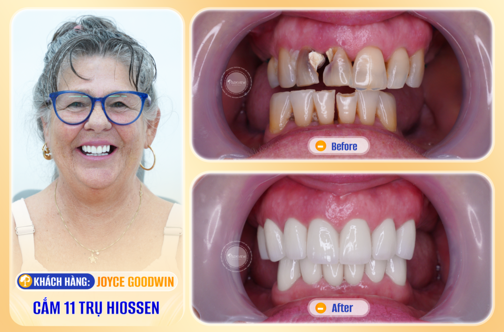 Trước và sau điều trị