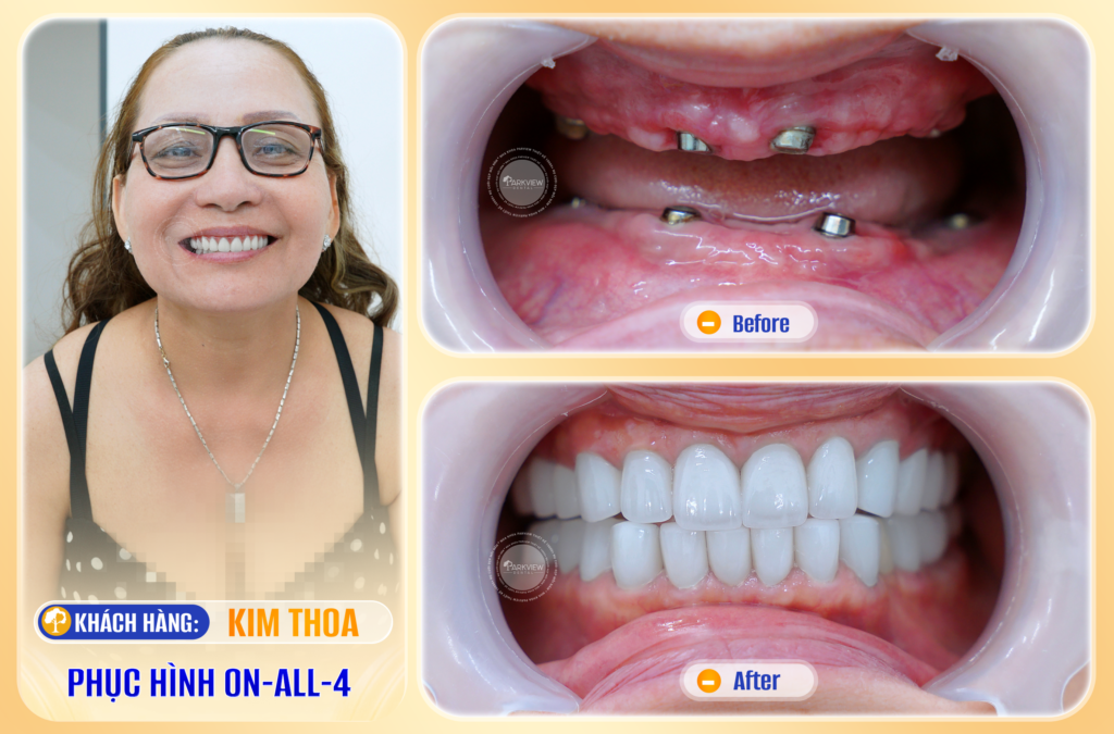 Trước và sau điều trị