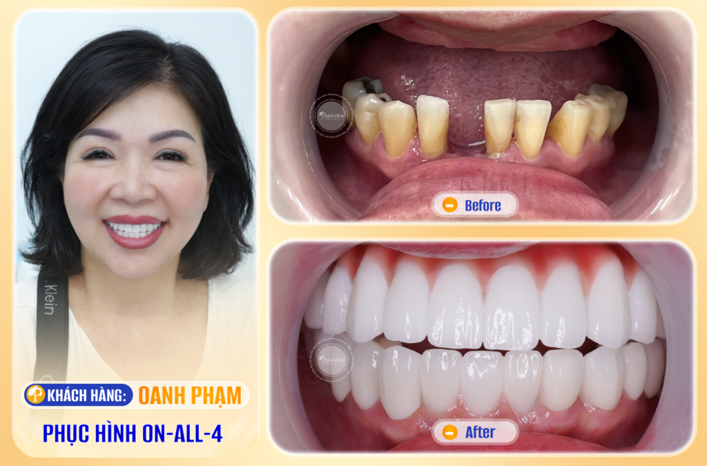 Trước và sau điều trị