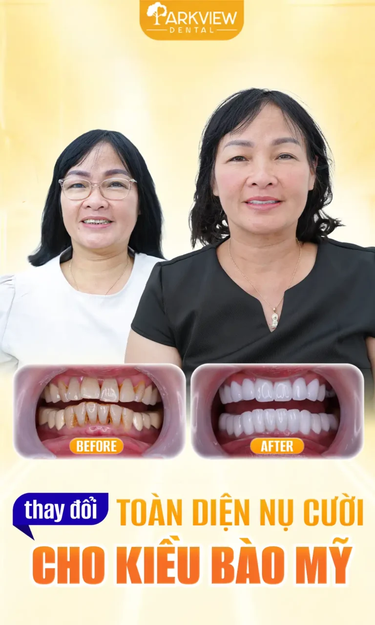 Ca Trồng Răng Implant Hiossen Cho Khách Hàng 56 Tuổi Từ Anh Quốc | Phục Hình Răng Toàn Hàm