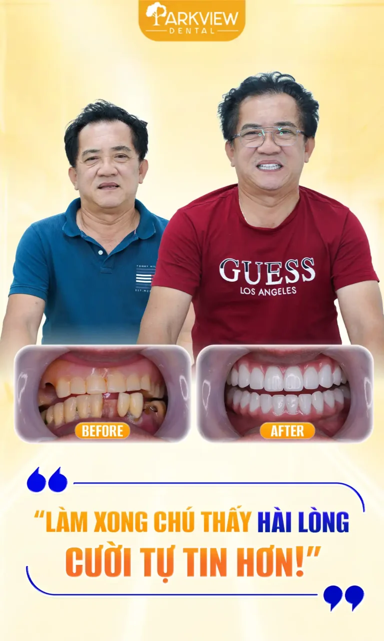 Mất Răng Toàn Hàm Gây Tiêu Xương – Giải Pháp Phục Hồi Ăn Nhai & Nụ Cười Tại Parkview Dental