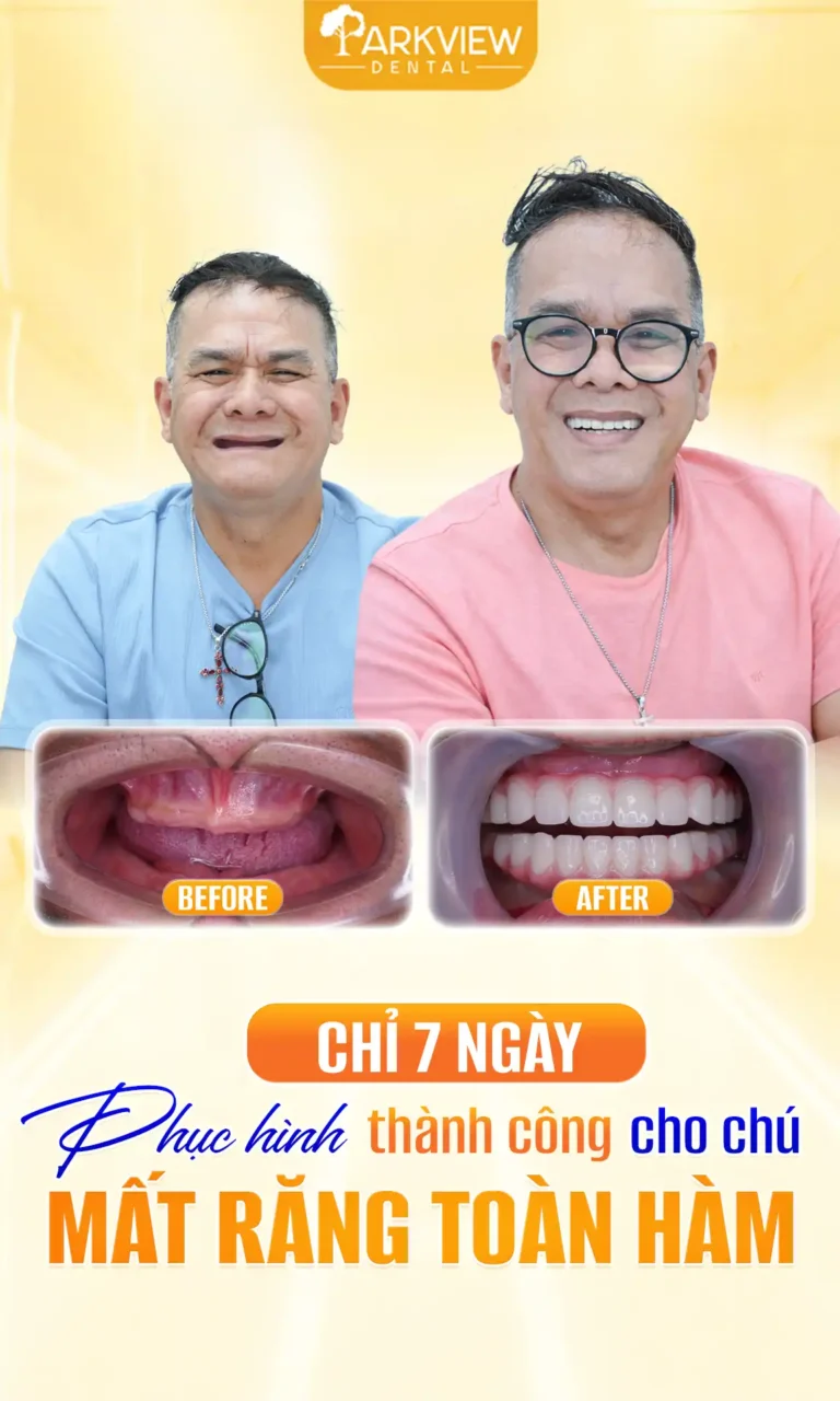 Mất Răng Toàn Hàm Lâu Năm Được Phục Hình Bằng Implant All-on-6 Chỉ Sau 7 Ngày