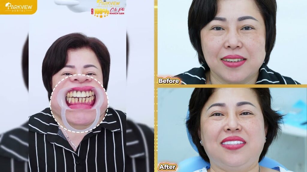Khách Hàng Tin Tưởng Cấy Ghép Implant Tại Parkview Dental Ngay Lần Đầu