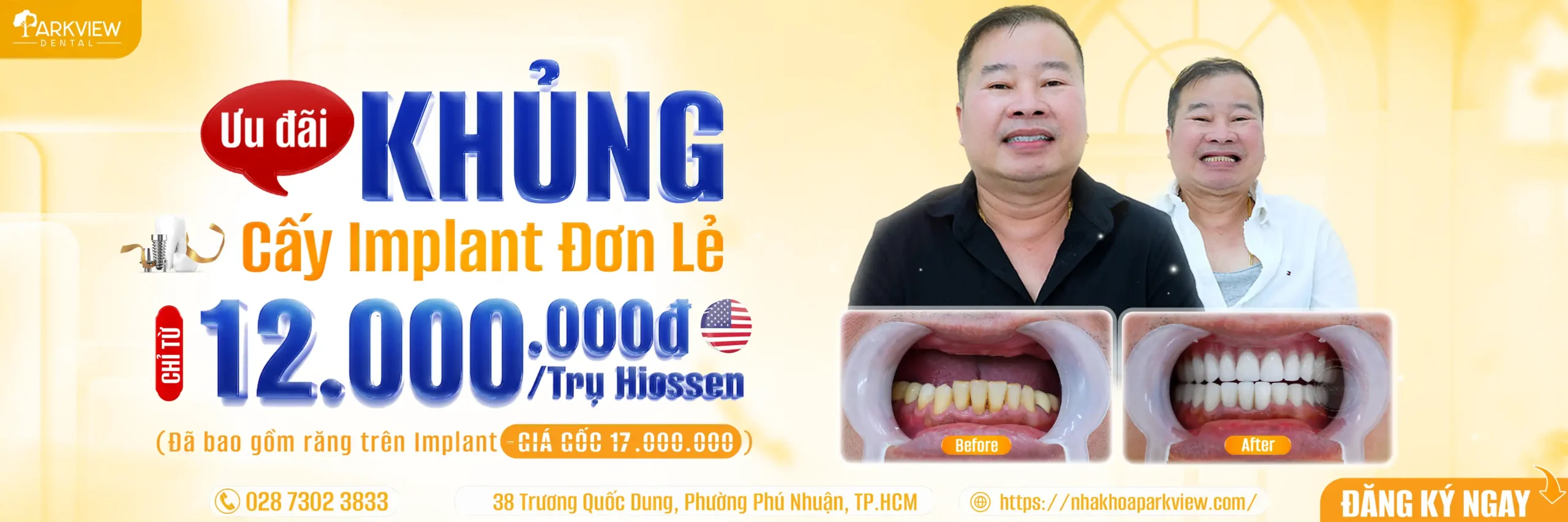 Trồng Răng implant hiossen