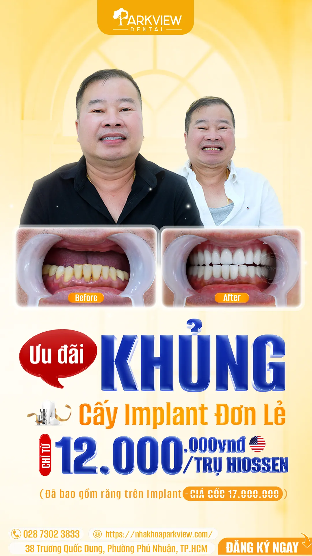 trong-rang-implant-hiossen