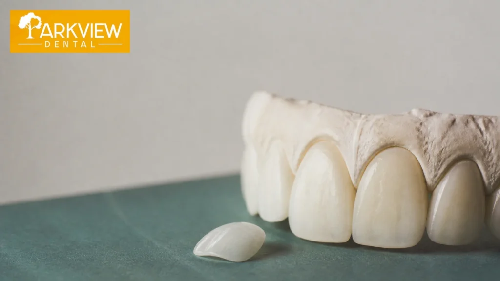 Dán sứ Veneer