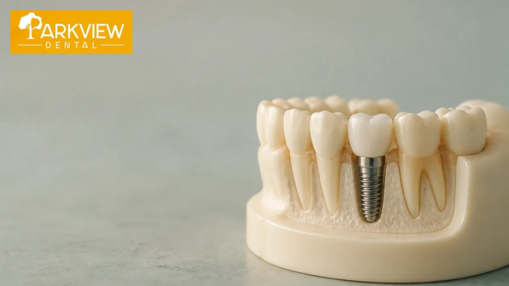 Implant đơn lẻ